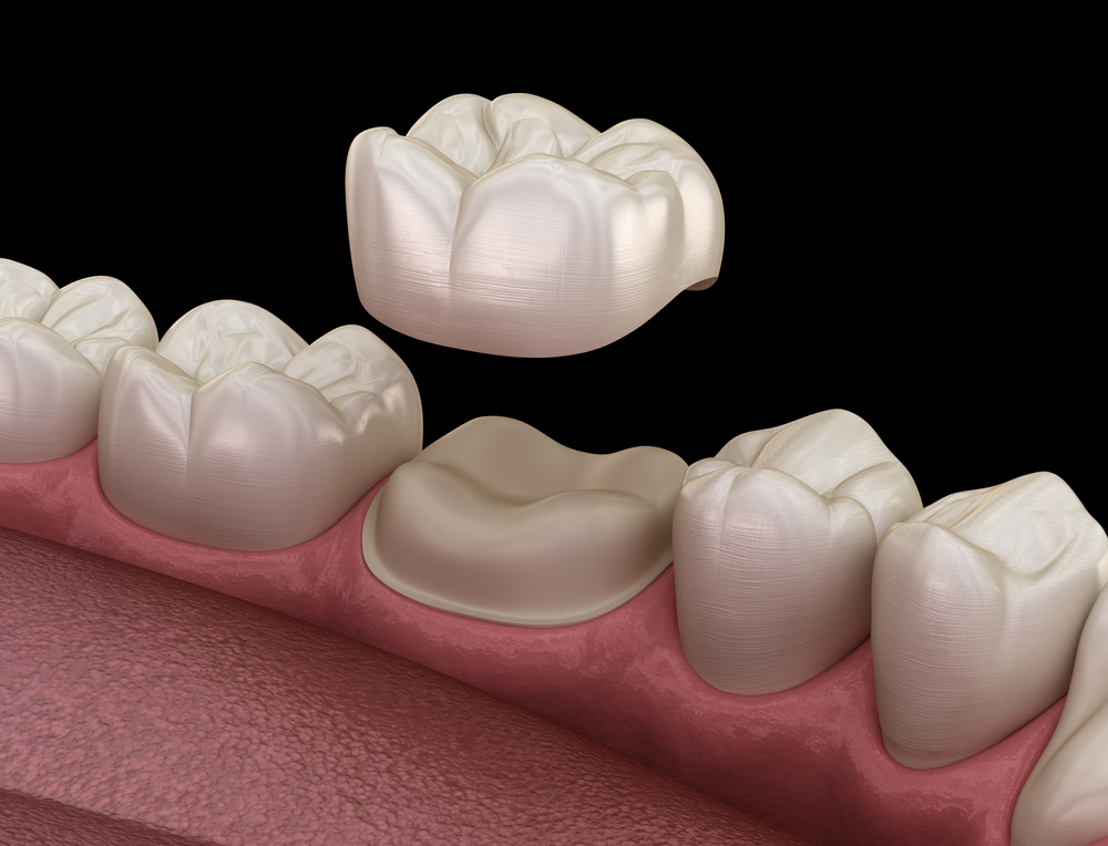 Bridges & Crowns - Mehta Dental Clinic